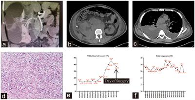 Atypical presentations of UTUC: a case report of three patients